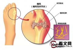 要想远离痛风，请谨记：晚上两不要，晨起两坚持