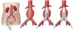 腹主动脉支架多少钱