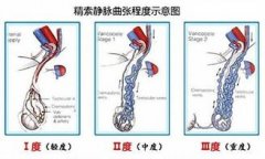 小腿静脉曲张夏天更严重吗