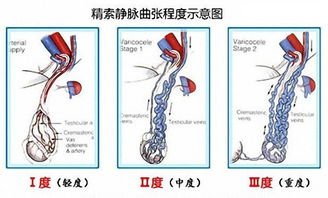 静脉曲张