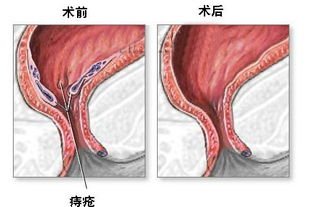 痔疮